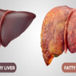 Fatty Liver ठीक होता है?