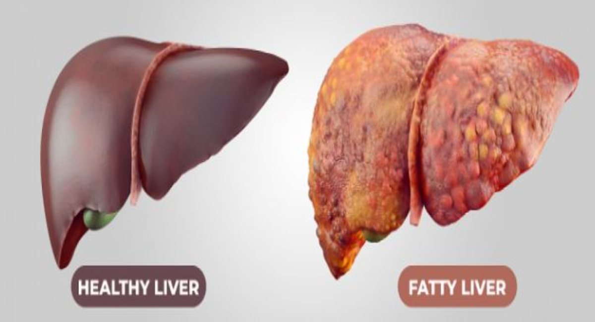 Fatty Liver ठीक होता है?