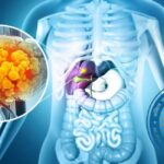 Fatty Liver को लेकर AIIMS के डॉक्टरों ने क्यों दी चेतावनी?