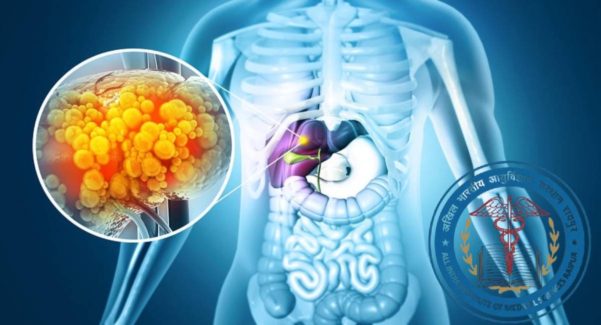 Fatty Liver को लेकर AIIMS के डॉक्टरों ने क्यों दी चेतावनी?